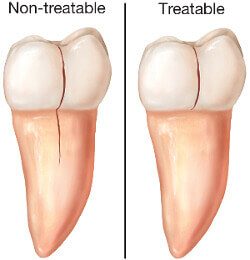 treatable cracked teeth