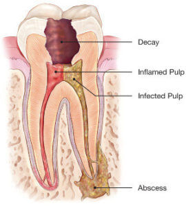 infected tooth root canal